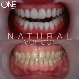 قشور خزفية ذات مظهر طبيعي و تفاصيل دقيقة تجعل الإبتسامه أجمل 

veneers with a natural look and fine details that make a smile more beautiful