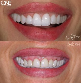 التخلص من الابتسامه اللثوية مع اعادة تصميم  جديد و دقيق للفينير ليبرز تفاصيل الابتسامه بمظهر طبيعي و اكثر جمالا